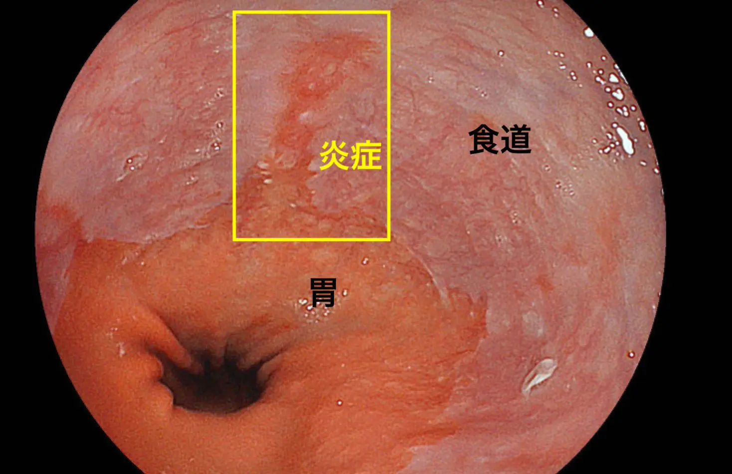 食道裂孔ヘルニアとは？症状・原因・治療を川崎区の内視鏡専門医が解説